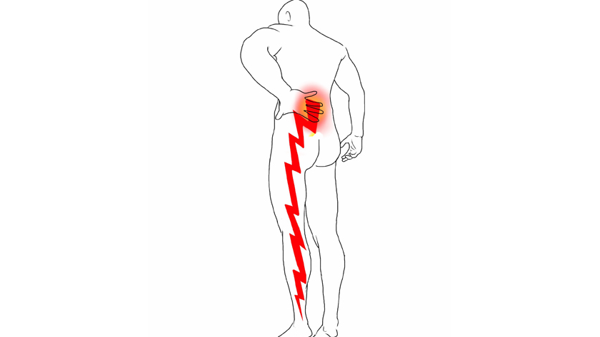 Sciatica pain highlighted